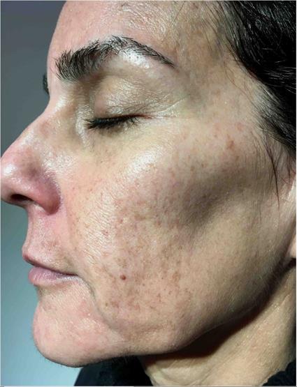 Laser Skin Resurfacing in Lafayette Brentwood CA Persons